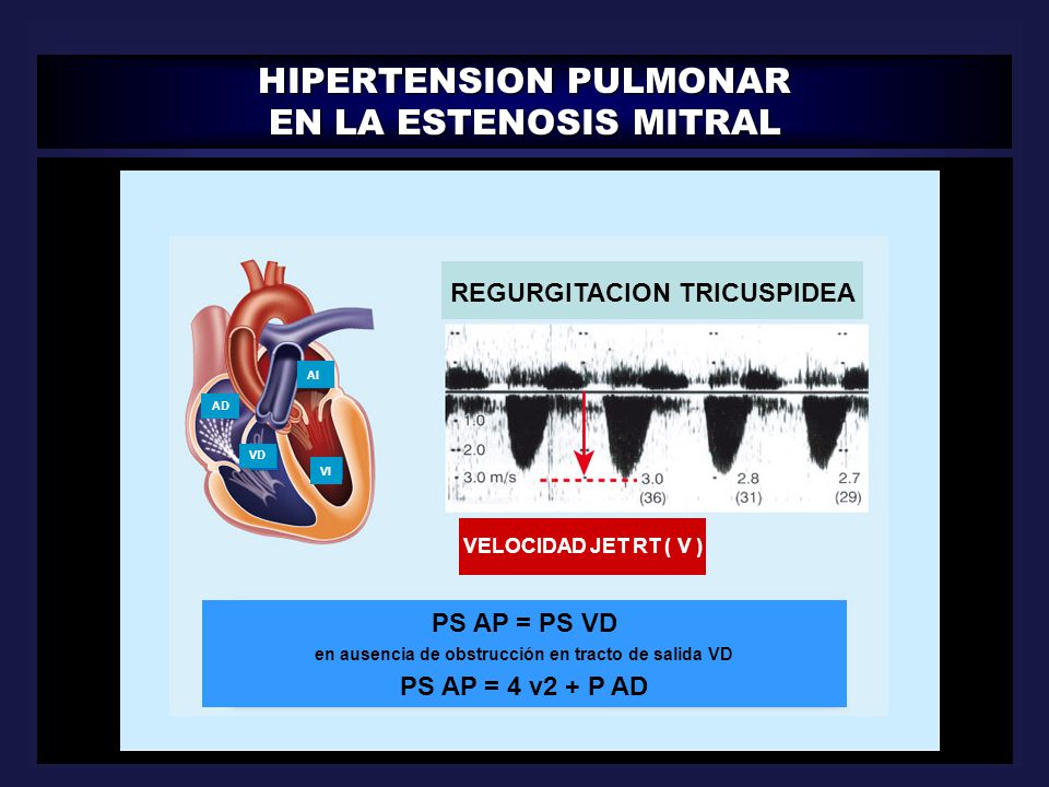 Regurgitación tricuspídea leve moderada hipertensión severa